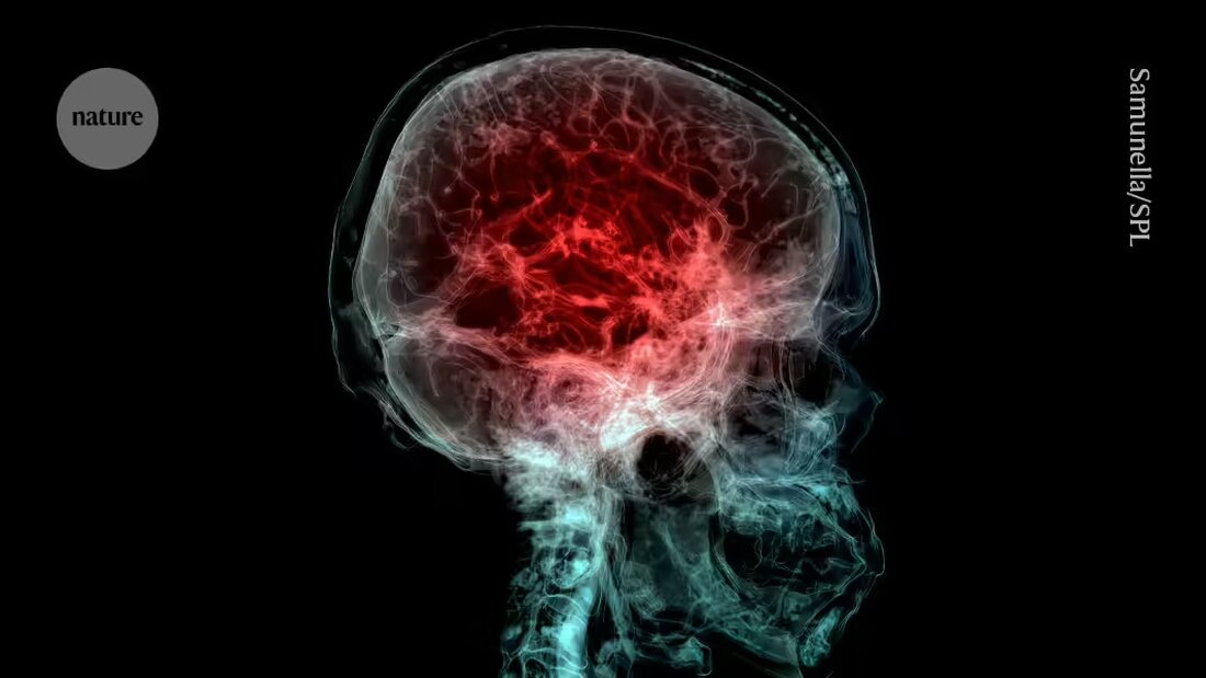 Erfahren Sie, wie sich menschliche Gehirne im Vergleich zu Schimpansen entwickelt haben und warum bestimmte Regionen des Gehirns anfälliger für Alterserscheinungen sind. Forscher haben mithilfe von MRT-Scans Datenkarten erstellt und herausgefunden, dass die evolutionäre Expansion des präfrontalen Kortex mit einem erhöhten Risiko für Alterserscheinungen verbunden ist. Lesen Sie mehr in dieser faszinierenden Studie aus der Zeitschrift Science Advances.