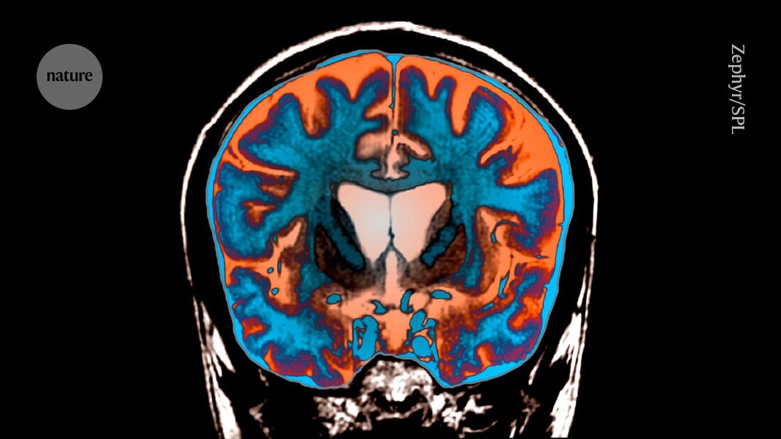 Erfahren Sie, warum das Huntington-Gen erst spät schädliche Auswirkungen zeigt, und welche neuen Erkenntnisse dazu gewonnen wurden.