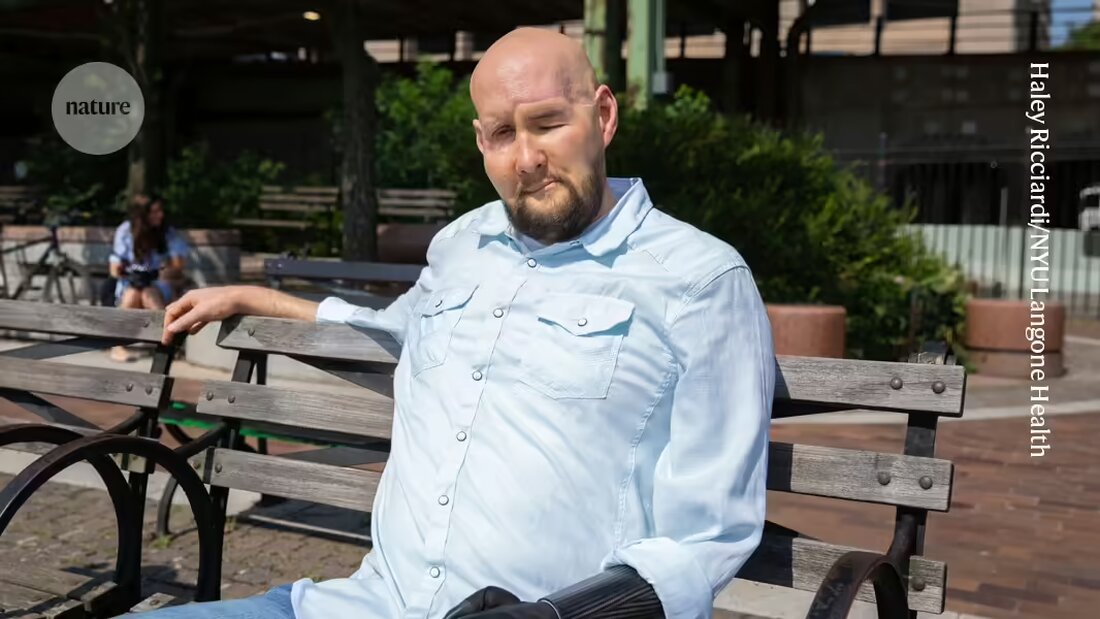 "Erfahren Sie alles über Aaron James, der 2023 die erste erfolgreiche Ganzaugen- und Gesichtstransplantation erhielt. Trotz der Herausforderungen und Risiken der Operation bleibt sein transplantiertes Auge gesund, auch wenn er nicht sehen kann. Dieser bahnbrechende medizinische Fortschritt bringt uns dem Ziel näher, eines Tages das Augenlicht durch Transplantationen wiederherzustellen. Lesen Sie mehr über die innovative Chirurgie und ihre Bedeutung für zukünftige Transplantationspatienten."