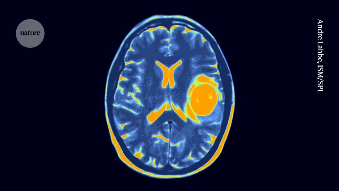 Erfahren Sie mehr über die vielversprechenden Ergebnisse der CAR-T-Zelltherapie gegen schwerwiegende zentrale Nervensystemkrebserkrankungen bei Kindern und wie Forscher daran arbeiten, den Erfolg auf mehr Patienten auszudehnen. Die Studien könnten wichtige Fortschritte in der Krebstherapie bringen.